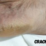 how to fix cracked heels permanently