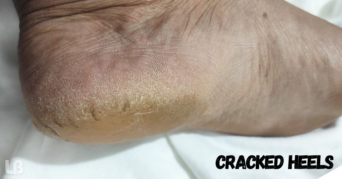 how to fix cracked heels permanently