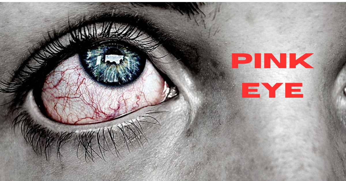 What is Commonly Misdiagnosed as Pink Eye